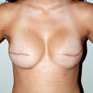 Breast Reconstruction Implants Before & After Gallery - Patient 285805 - Image 2