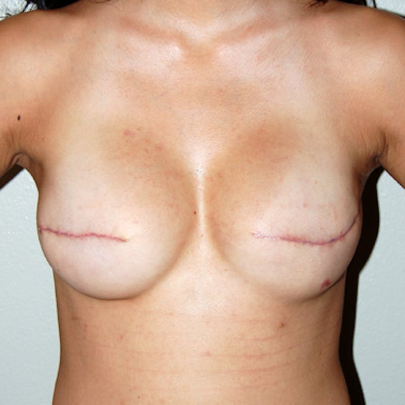 Breast Reconstruction Implants Before & After Gallery - Patient 285805 - Image 2