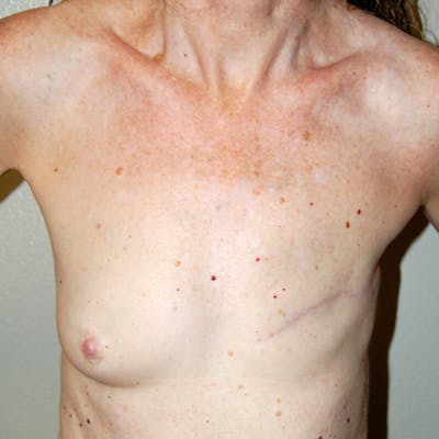 Breast Reconstruction Implants Before & After Gallery - Patient 888175 - Image 1