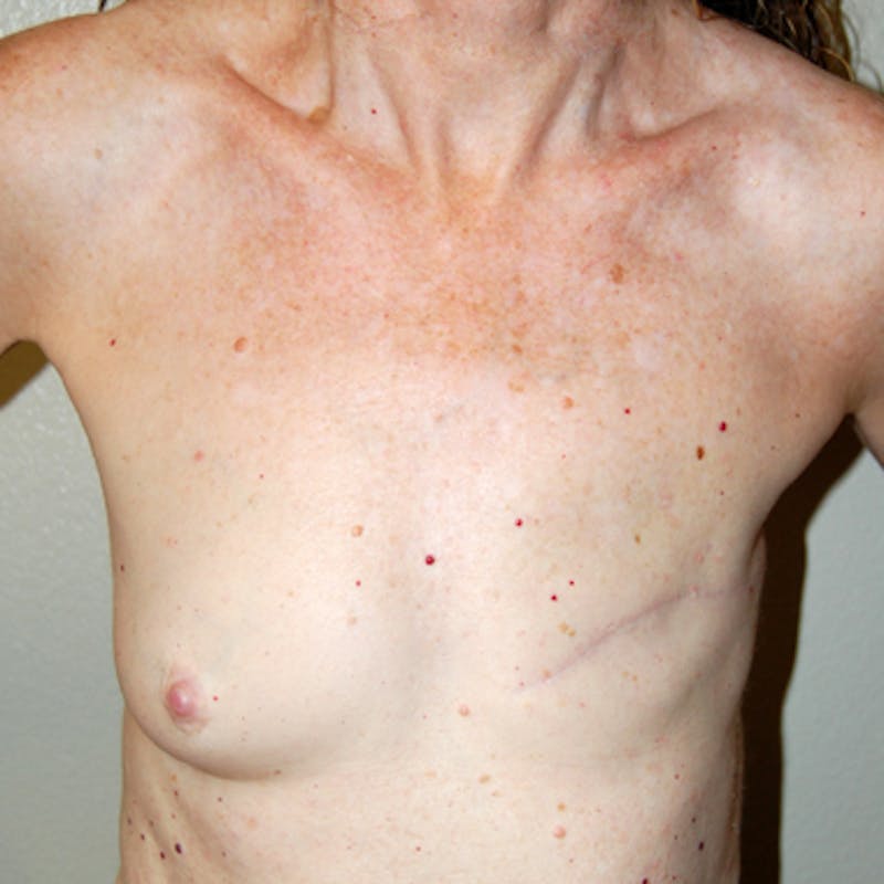 Breast Reconstruction Implants Before & After Gallery - Patient 888175 - Image 1