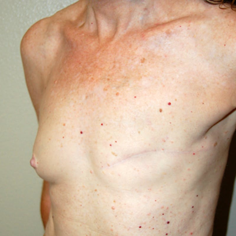 Breast Reconstruction Implants Before & After Gallery - Patient 888175 - Image 3