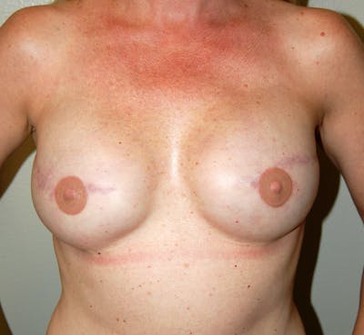 Breast Reconstruction Implants Before & After Gallery - Patient 779098 - Image 2