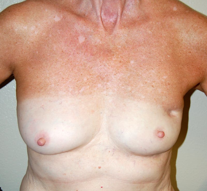 Breast Reconstruction Implants Before & After Gallery - Patient 110553 - Image 1