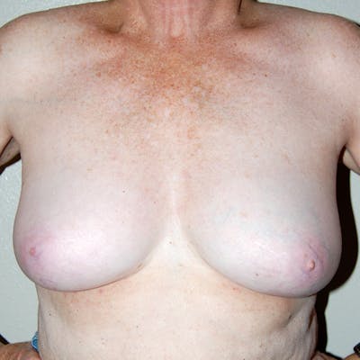 Breast Reconstruction Implants Before & After Gallery - Patient 402182 - Image 1