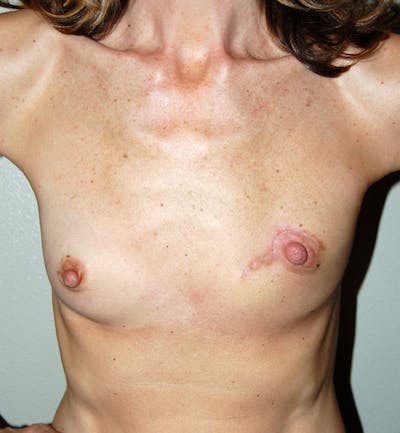Breast Reconstruction Implants Before & After Gallery - Patient 206160 - Image 1