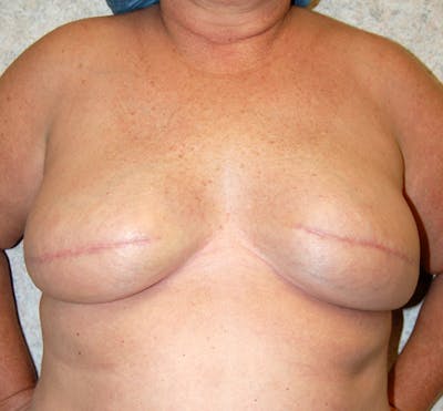 Breast Reconstruction Implants Before & After Gallery - Patient 386205 - Image 2