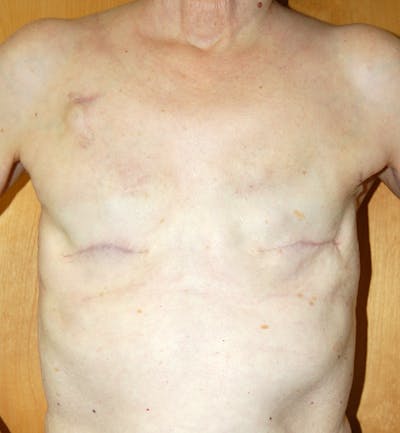 Breast Reconstruction Implants Before & After Gallery - Patient 372096 - Image 1