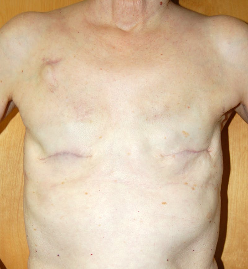 Breast Reconstruction Implants Before & After Gallery - Patient 372096 - Image 1