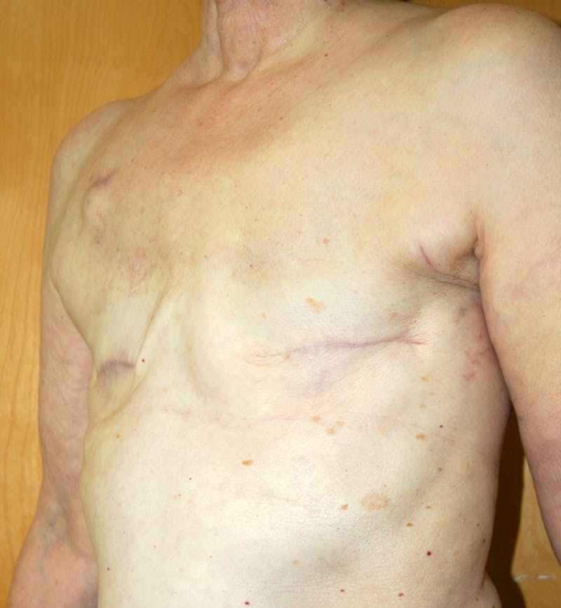 Breast Reconstruction Implants Before & After Gallery - Patient 372096 - Image 3