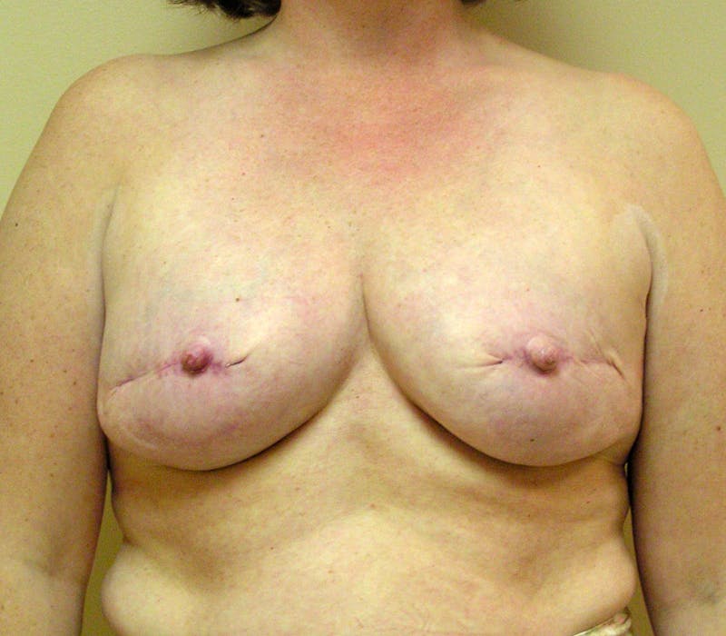 Breast Reconstruction Implants Before & After Gallery - Patient 149145 - Image 1