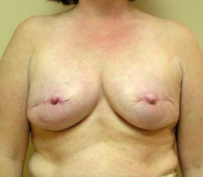 Breast Reconstruction Implants Before & After Gallery - Patient 149145 - Image 1