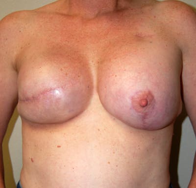 Breast Reconstruction Implants Before & After Gallery - Patient 255607 - Image 2