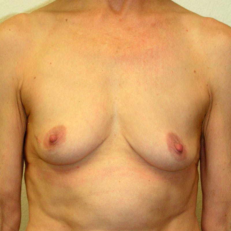 Breast Reconstruction Implants Before & After Gallery - Patient 320949 - Image 1
