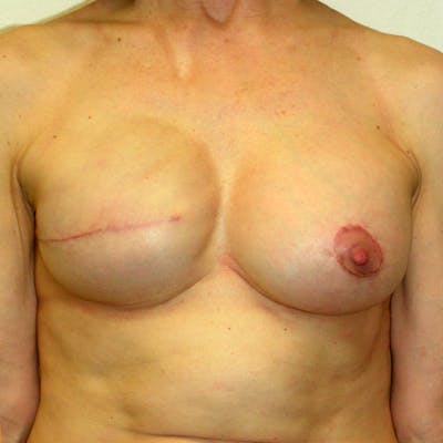 Breast Reconstruction Implants Before & After Gallery - Patient 320949 - Image 2