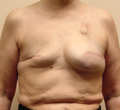 Breast Reconstruction Implants Before & After Gallery - Patient 180065 - Image 1