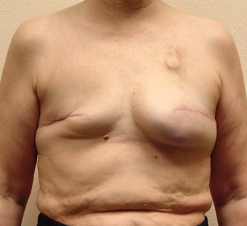 Breast Reconstruction Implants Before & After Gallery - Patient 180065 - Image 1