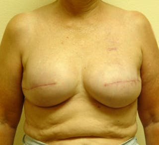 Breast Reconstruction Implants Before & After Gallery - Patient 180065 - Image 2