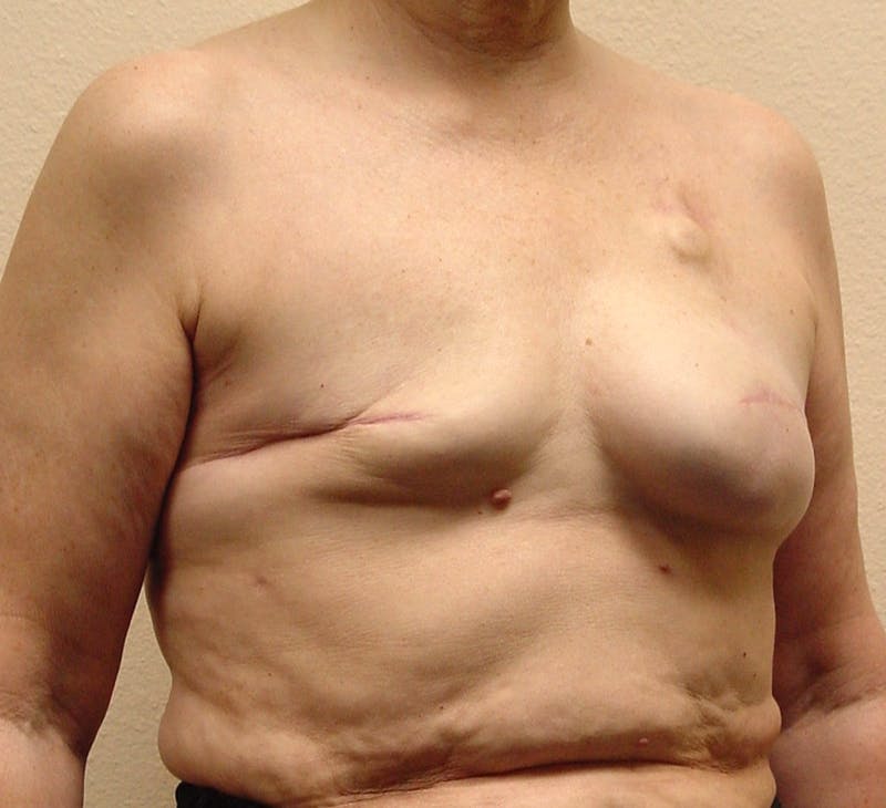 Breast Reconstruction Implants Before & After Gallery - Patient 180065 - Image 3