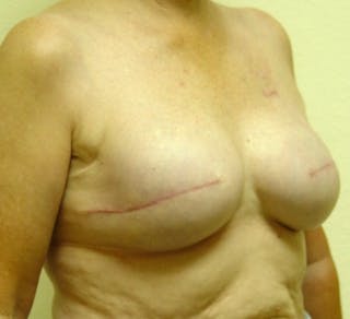 Breast Reconstruction Implants Before & After Gallery - Patient 180065 - Image 4