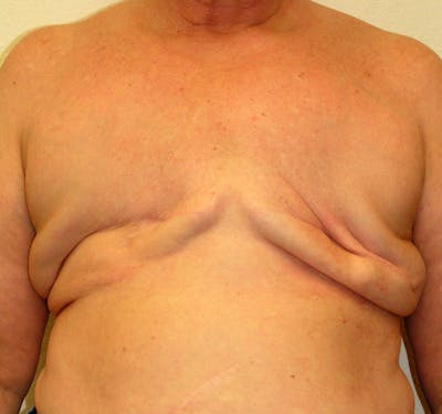 Breast Reconstruction Implants Before & After Gallery - Patient 277849 - Image 1