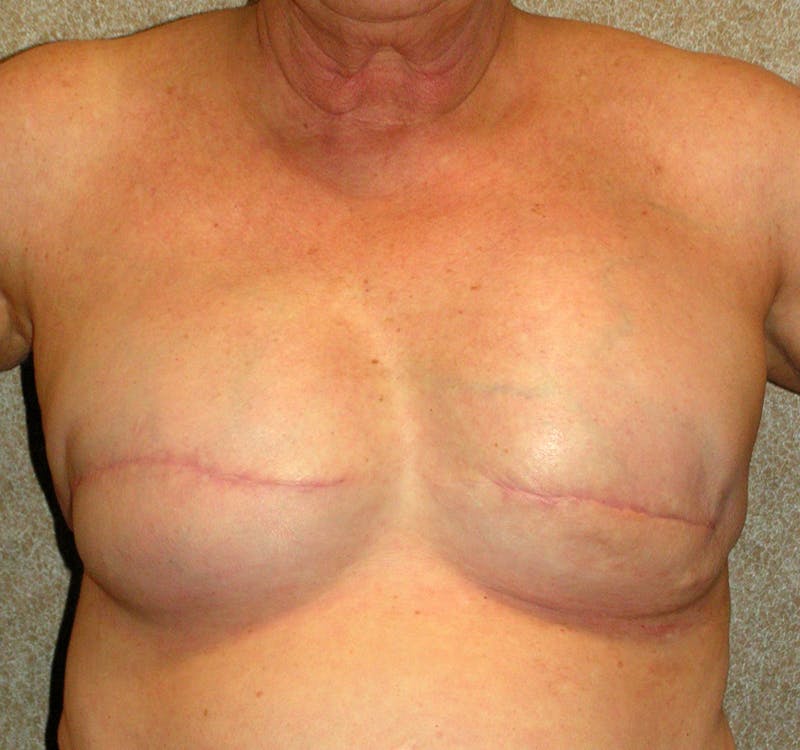 Breast Reconstruction Implants Before & After Gallery - Patient 277849 - Image 2