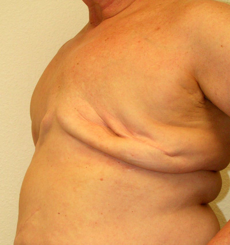 Breast Reconstruction Implants Before & After Gallery - Patient 277849 - Image 3