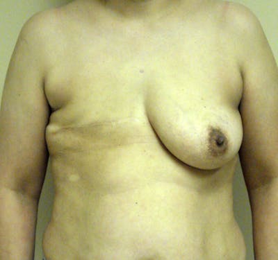 Breast Reconstruction Implants Before & After Gallery - Patient 357408 - Image 1