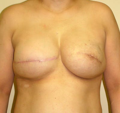 Breast Reconstruction Implants Before & After Gallery - Patient 357408 - Image 2