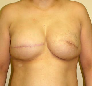 Breast Reconstruction Implants Before & After Gallery - Patient 357408 - Image 2