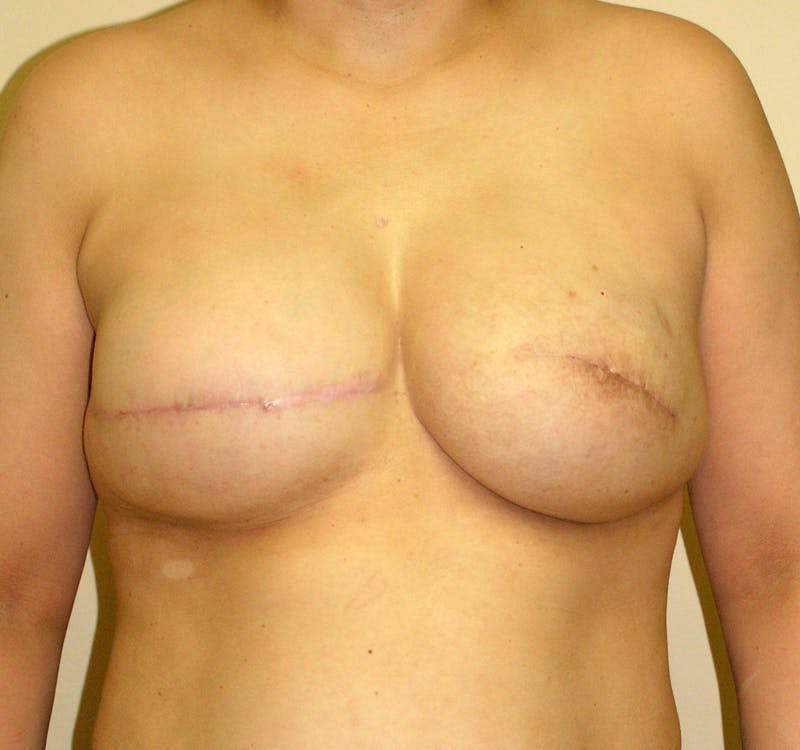 Breast Reconstruction Implants Before & After Gallery - Patient 357408 - Image 2