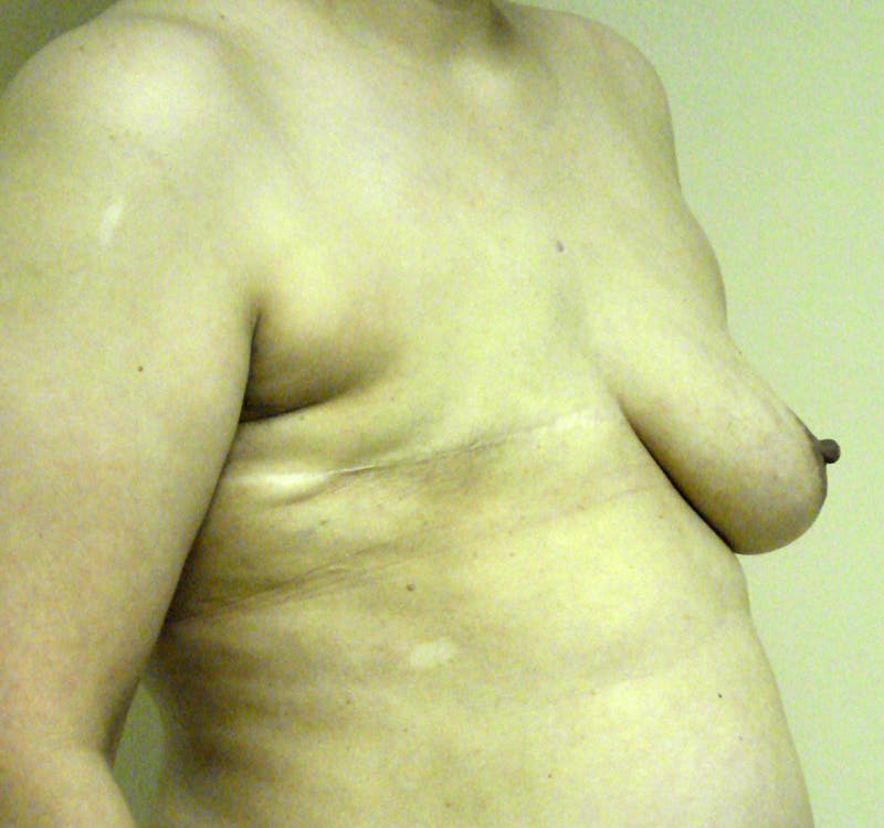 Breast Reconstruction Implants Before & After Gallery - Patient 357408 - Image 3