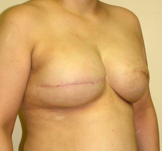 Breast Reconstruction Implants Before & After Gallery - Patient 357408 - Image 4