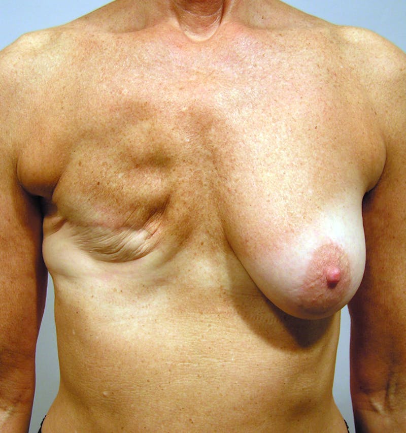 Breast Reconstruction Implants Before & After Gallery - Patient 168135 - Image 1