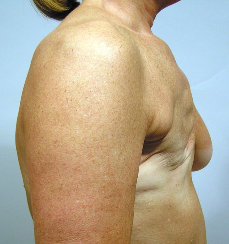 Breast Reconstruction Implants Before & After Gallery - Patient 168135 - Image 3