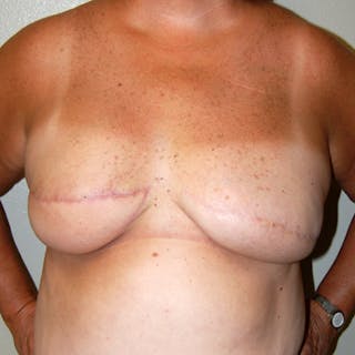 Breast Reconstruction Latissimus Before & After Gallery - Patient 336866 - Image 2