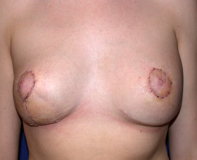 Breast Reconstruction Latissimus Before & After Gallery - Patient 262846 - Image 2