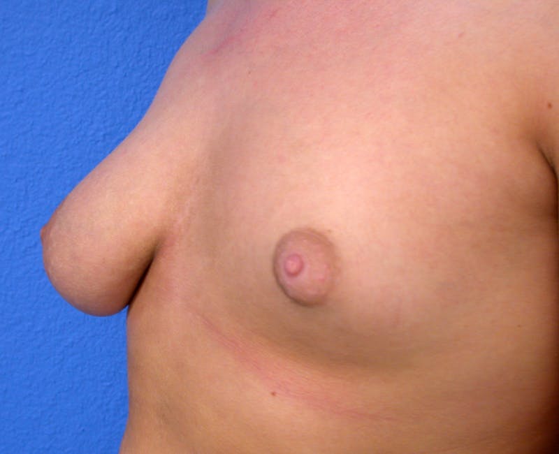 Breast Reconstruction Latissimus Before & After Gallery - Patient 262846 - Image 3