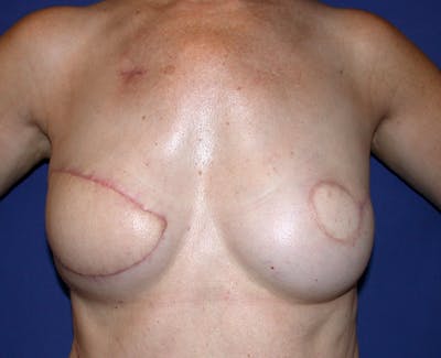 Breast Reconstruction Latissimus Before & After Gallery - Patient 296432 - Image 1
