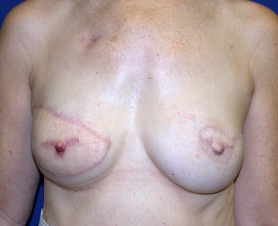 Breast Reconstruction Latissimus Before & After Gallery - Patient 296432 - Image 2