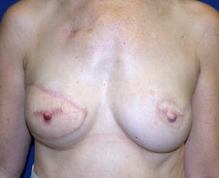 Breast Reconstruction Latissimus Before & After Gallery - Patient 296432 - Image 2