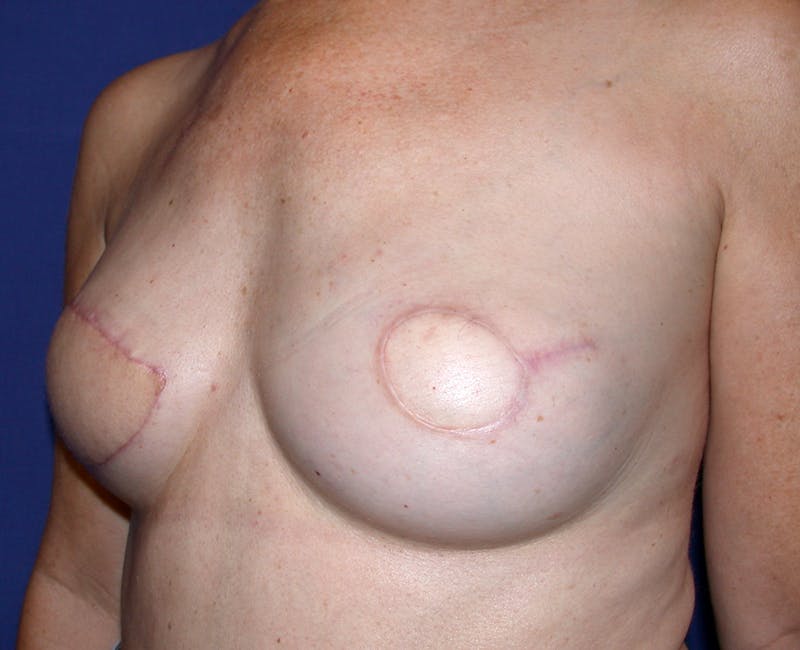 Breast Reconstruction Latissimus Before & After Gallery - Patient 296432 - Image 3