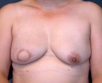 Breast Reconstruction Latissimus Before & After Gallery - Patient 215862 - Image 1