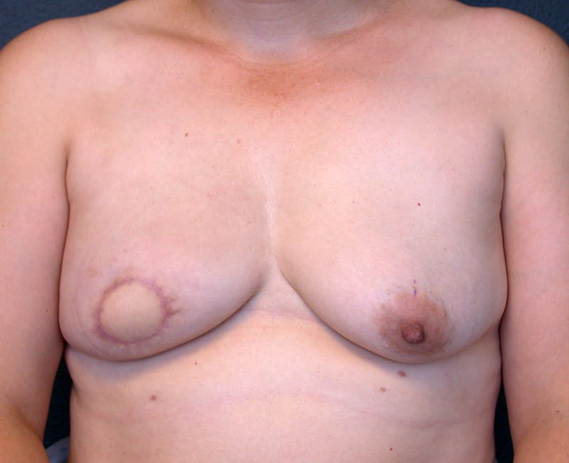 Breast Reconstruction Latissimus Before & After Gallery - Patient 215862 - Image 1