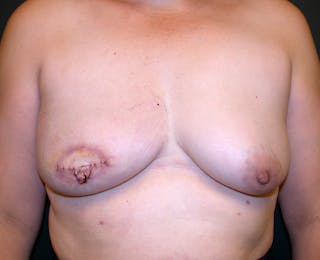 Breast Reconstruction Latissimus Before & After Gallery - Patient 215862 - Image 2