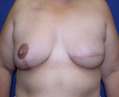 Breast Reconstruction Latissimus Before & After Gallery - Patient 420399 - Image 2