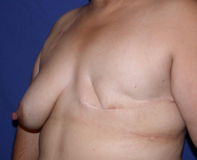 Breast Reconstruction Latissimus Before & After Gallery - Patient 420399 - Image 3