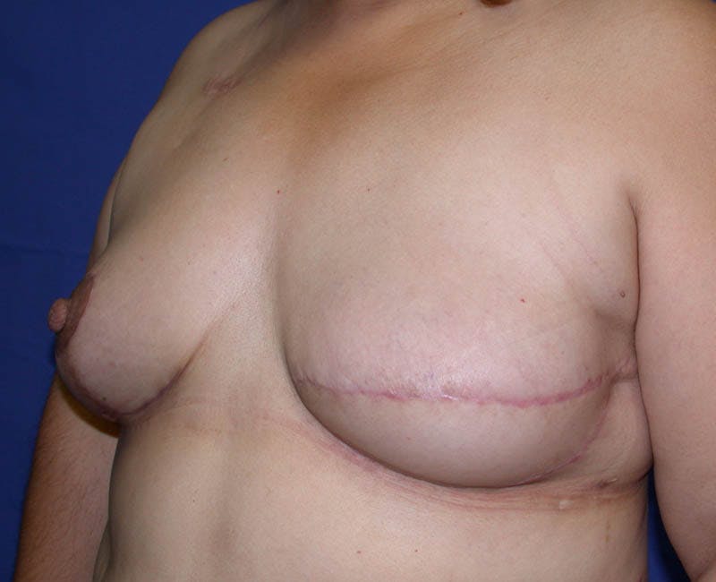 Breast Reconstruction Latissimus Before & After Gallery - Patient 420399 - Image 4