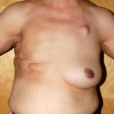 Breast Reconstruction TRAM Before & After Gallery - Patient 649326 - Image 1