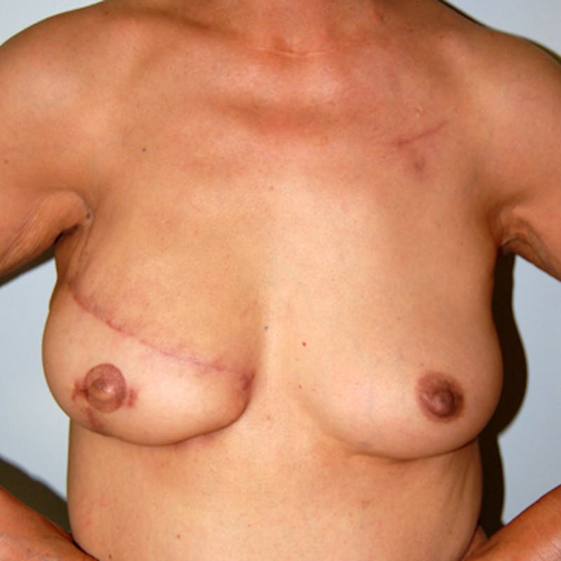 Breast Reconstruction TRAM Before & After Gallery - Patient 649326 - Image 2