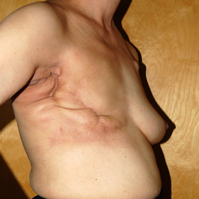 Breast Reconstruction TRAM Before & After Gallery - Patient 649326 - Image 3